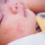 راش گرمایی در نوزادان چیست؟ دانه‌های قرمز روی پوست کودک چرا ایجاد می‌شوند و چگونه درمان می‌شوند؟